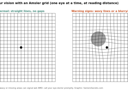 Illustration of a normal Amsler grid next to one showing wavy lines and a dark spot, the warning signs of macular degeneration