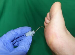 A clinician pressing a thin monofilament against the sole of a patient's foot to test sensation
